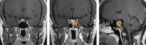 Pituitary MRI showing tumor left behind from a previous surgery, which was then removed at UCSF