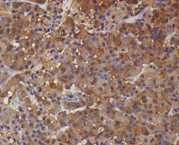 ACTH-secreting pituitary adenoma