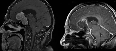 MRIs showing before and after surgery for pituitary adenoma