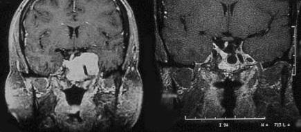 Prolactinoma treated with cabergoline