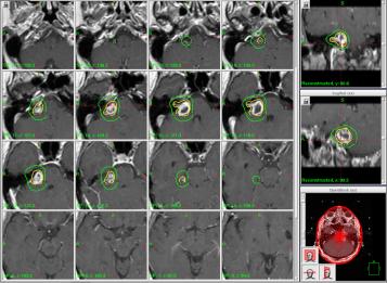 Gamma Knife Radiosurgery Plan at UCSF