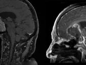 MRIs showing before and after surgery for pituitary adenoma